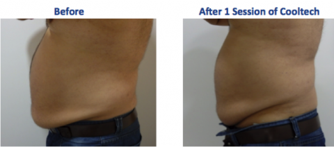 Cooltech FAT FREEZING | CK Medical Center